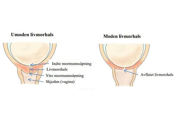 Illustrasjon som viser ein umoden livmorhals og ein moden livmorhals i høve fødsel