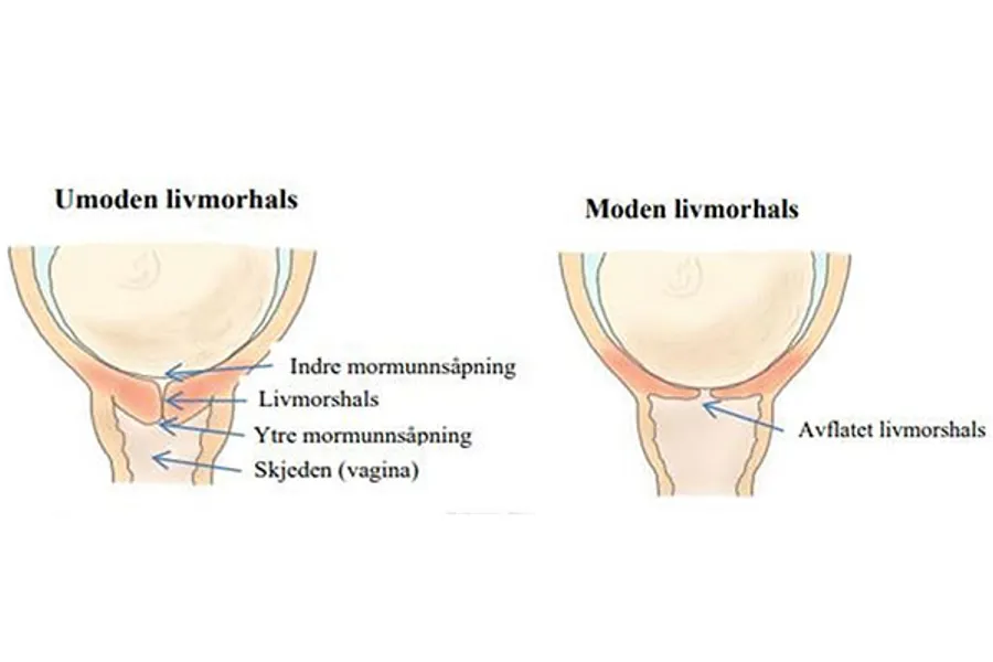 Illustrasjon som viser ein umoden livmorhals og ein moden livmorhals i høve fødsel