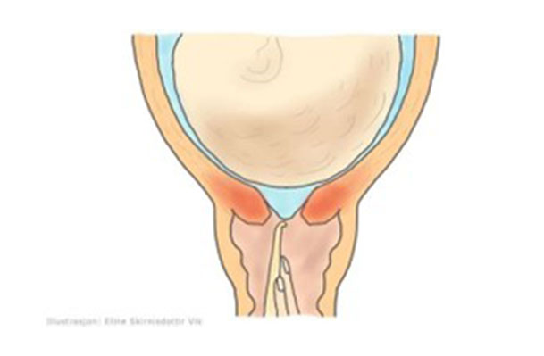 Illustrasjon av ein livmorhals