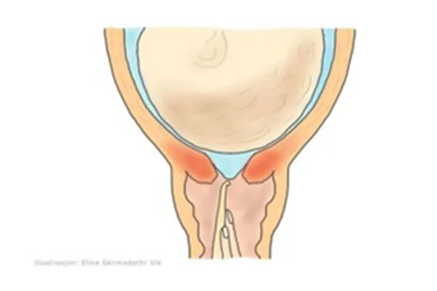 Illustrasjon av ein livmorhals