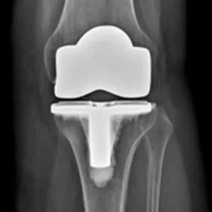 Et nærbilde av et menneskebein