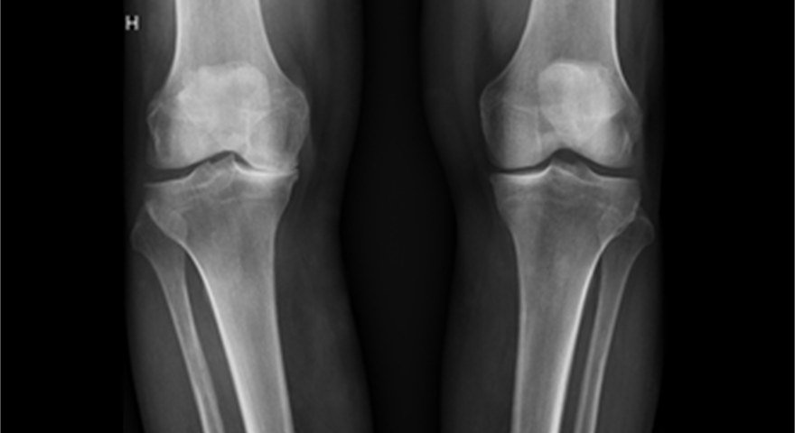 Røntgen av en persons ben