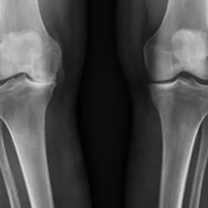 Røntgen av en persons ben